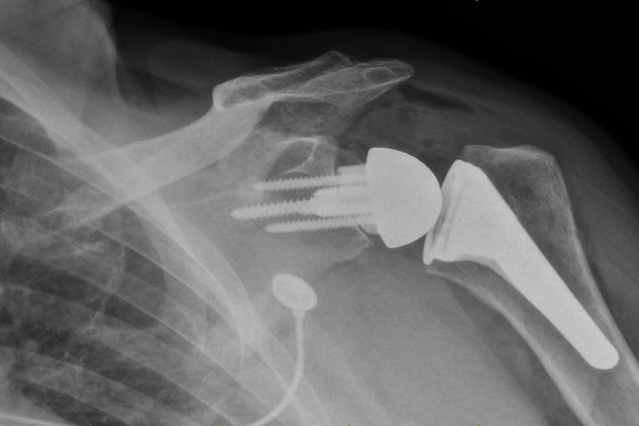 Gallbladder Surgery Boise